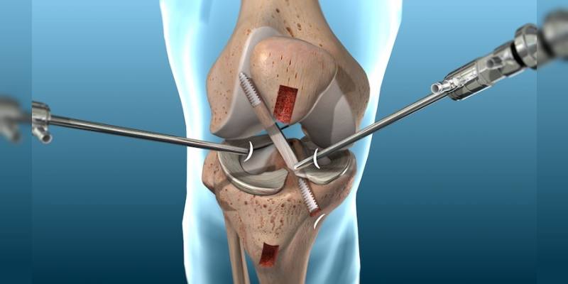 Arthroscopie du Genou - Orthoist